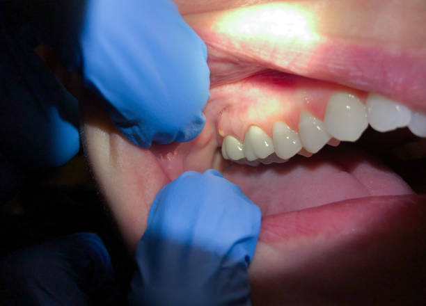 Best Emergency Treatment for Dental Infections or Abscesses in Saylorville, IA
